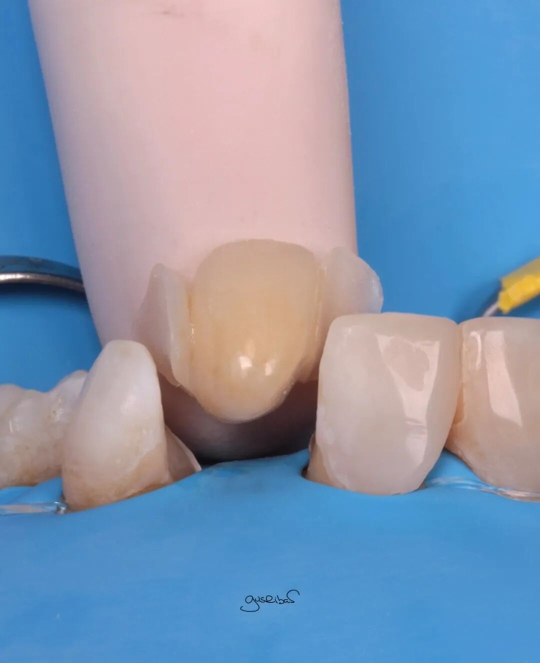 看个马里兰桥修复，感觉好复杂