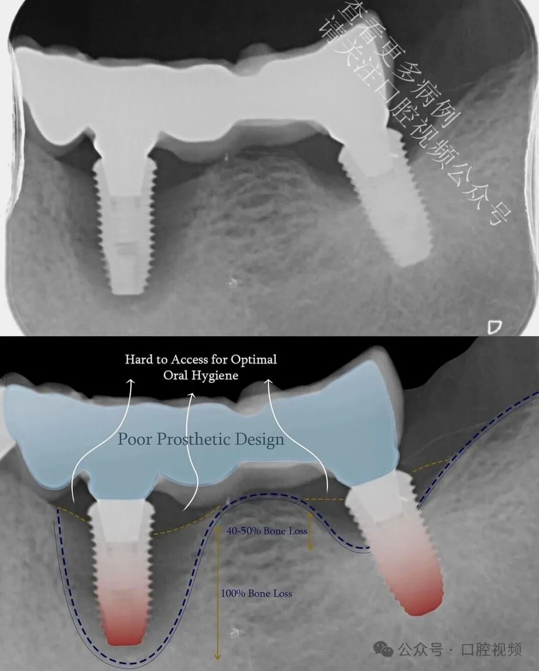 自然的骨增量，“奇怪”的现象