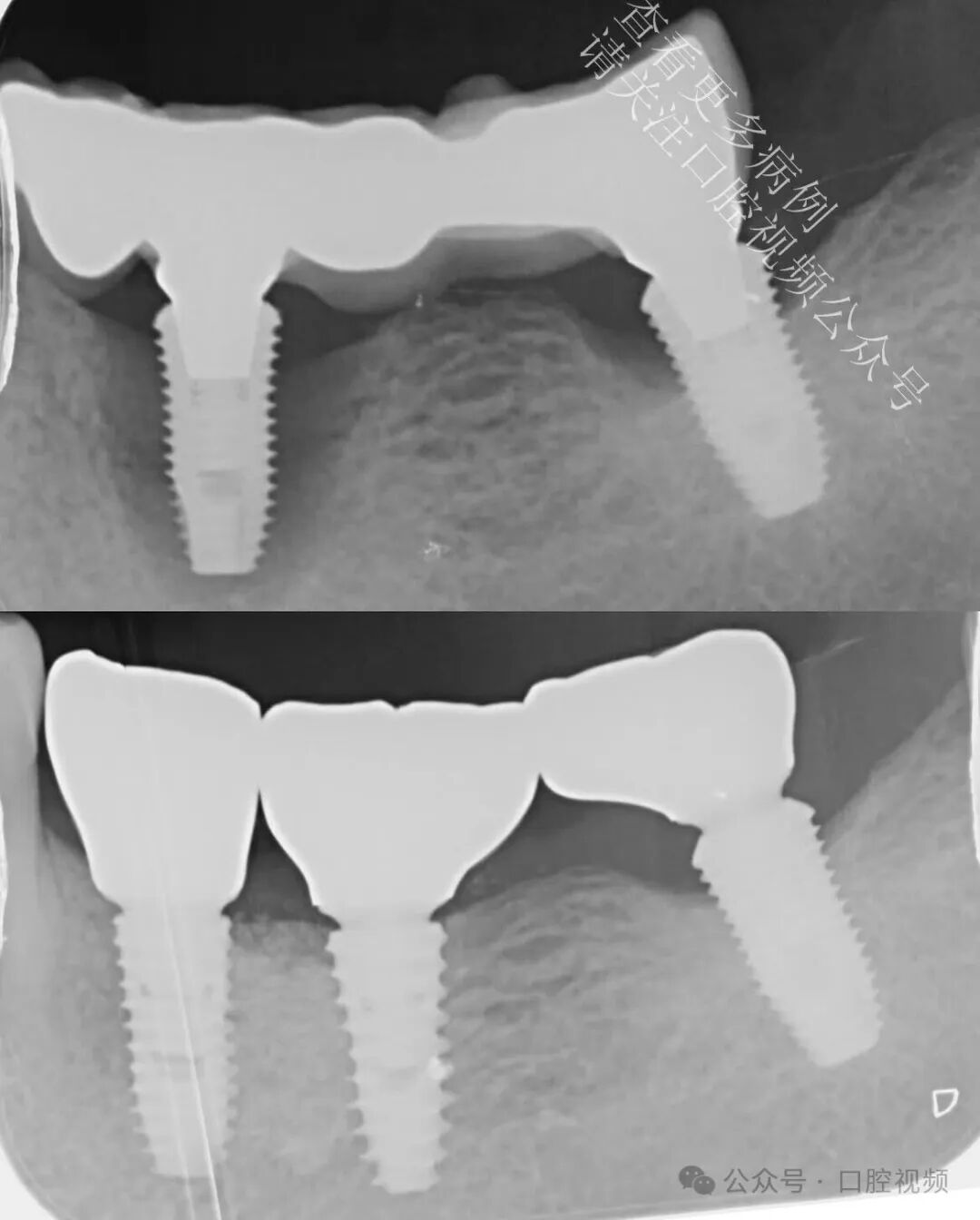 自然的骨增量，“奇怪”的现象