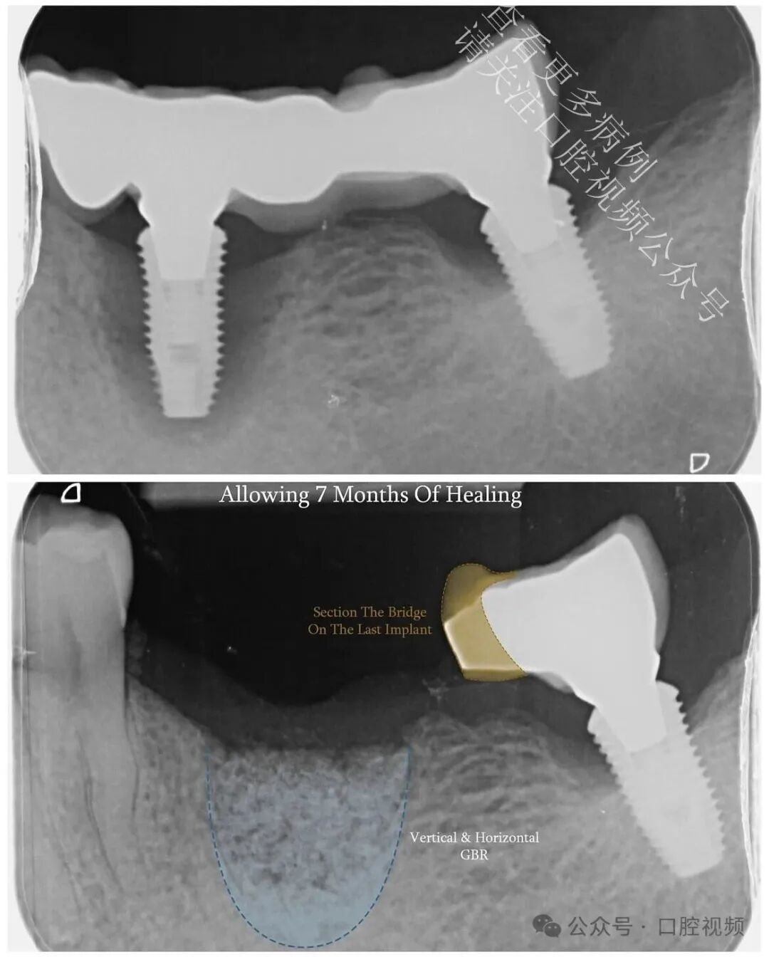 自然的骨增量，“奇怪”的现象