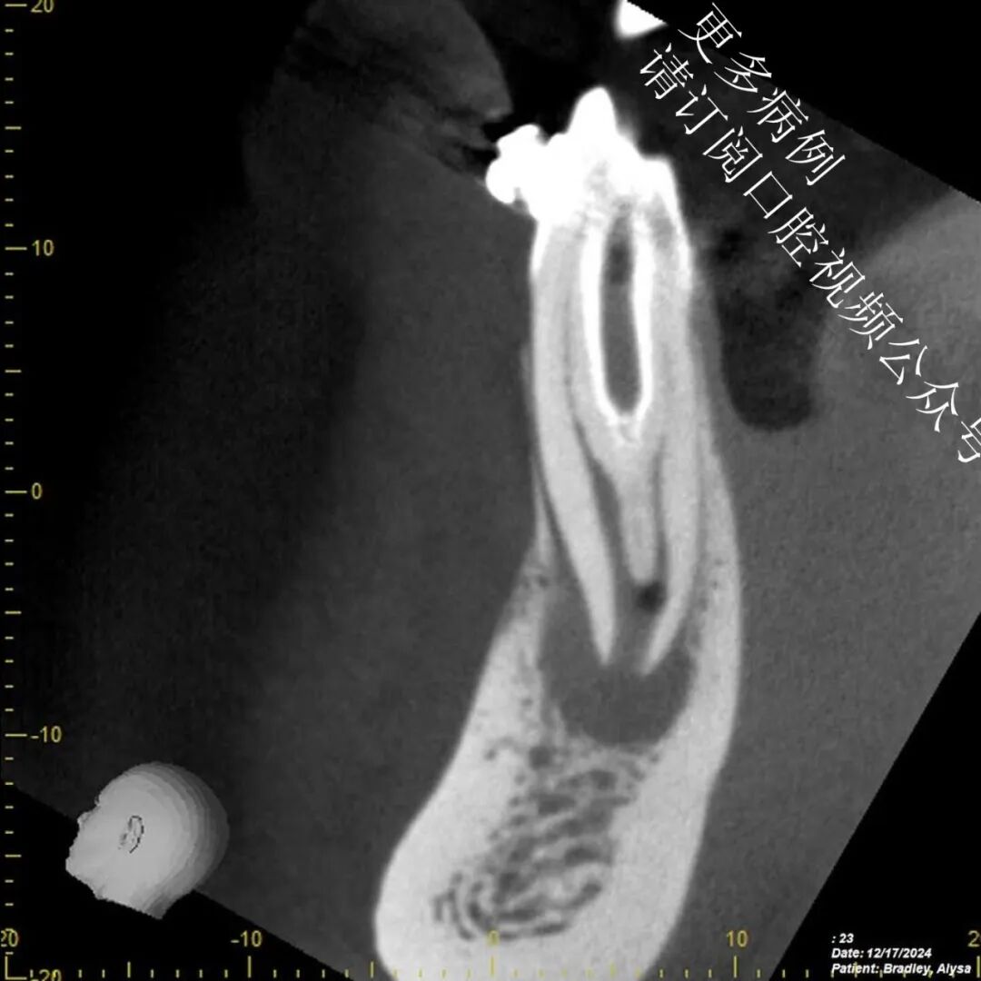 一个比较棘手的根管治疗案例