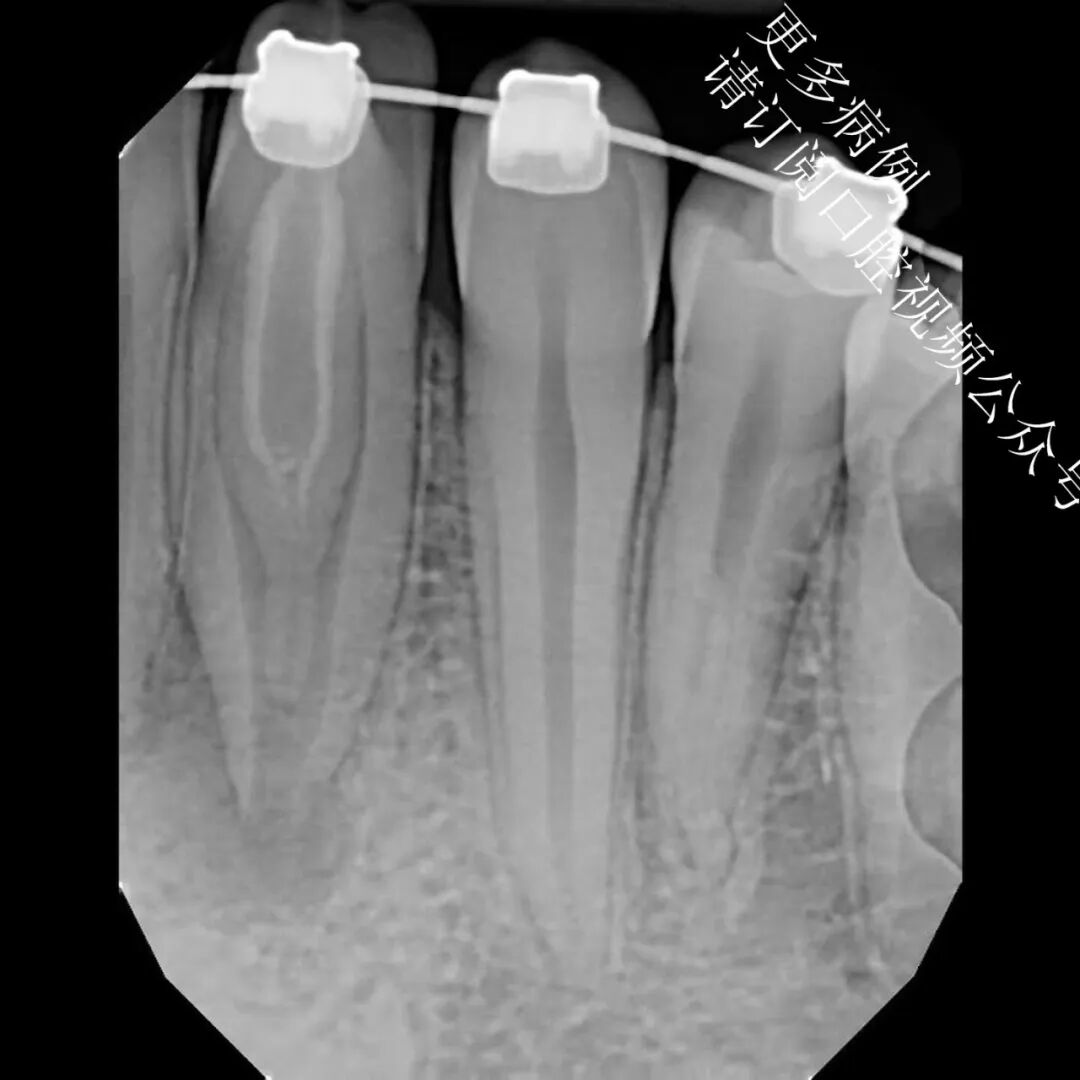 一个比较棘手的根管治疗案例
