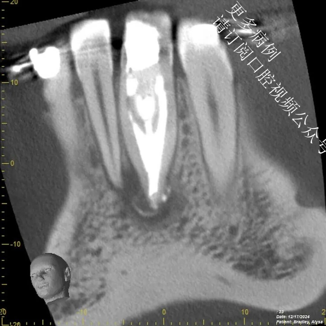 一个比较棘手的根管治疗案例