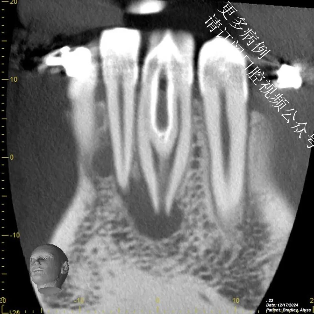 一个比较棘手的根管治疗案例