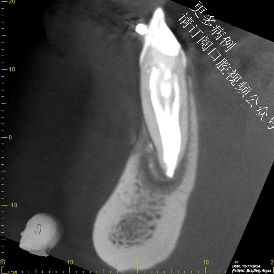 一个比较棘手的根管治疗案例