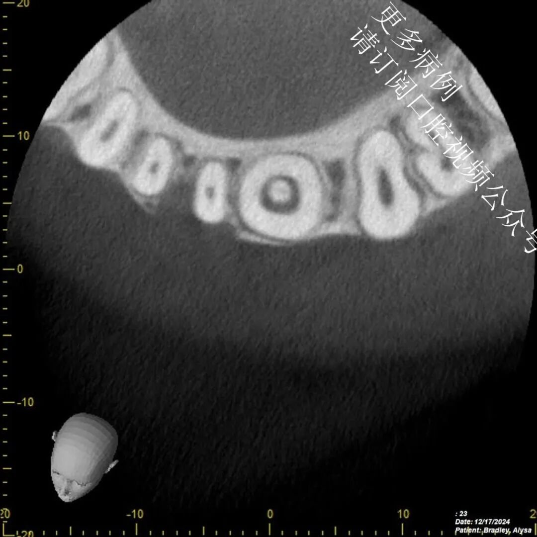 一个比较棘手的根管治疗案例