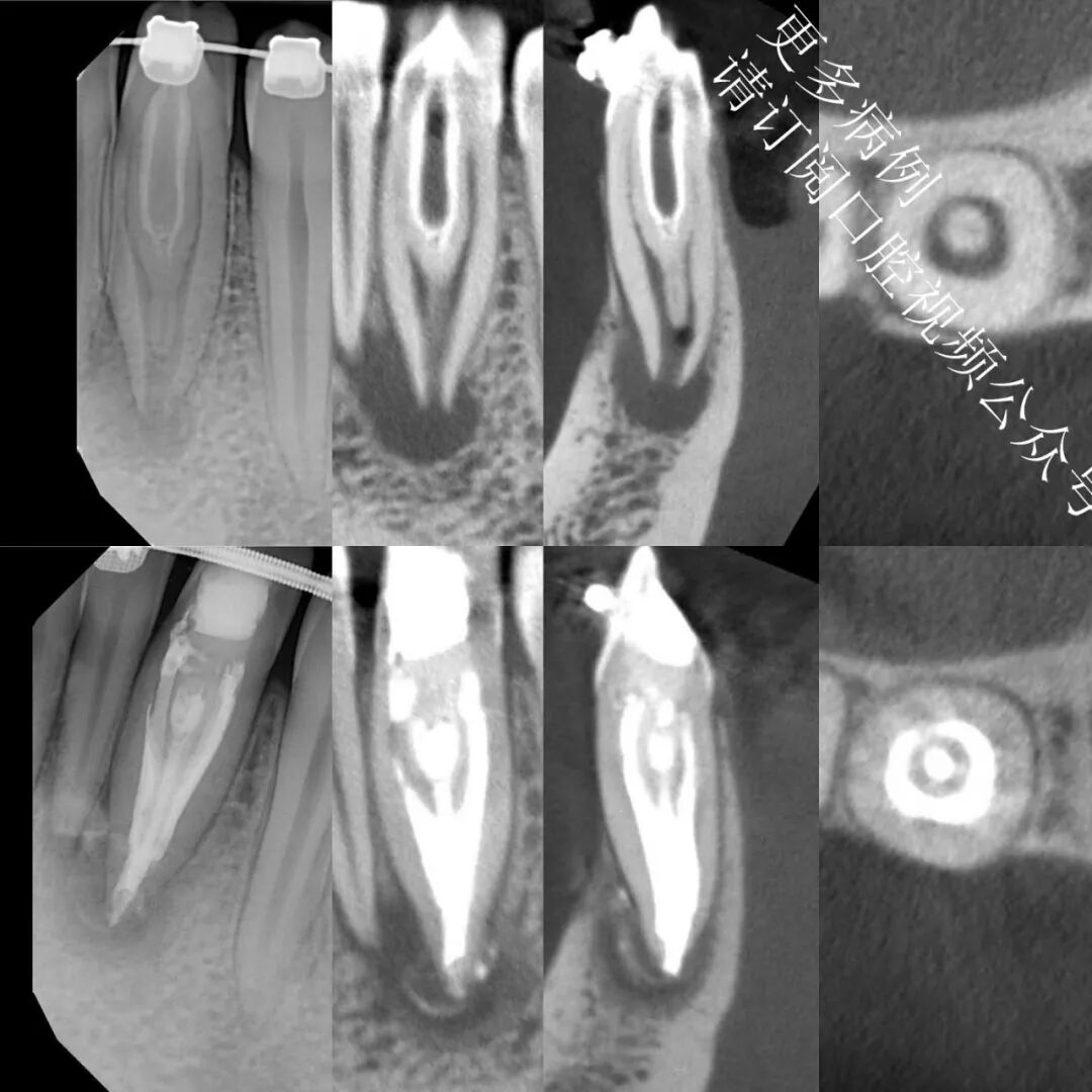 一个比较棘手的根管治疗案例