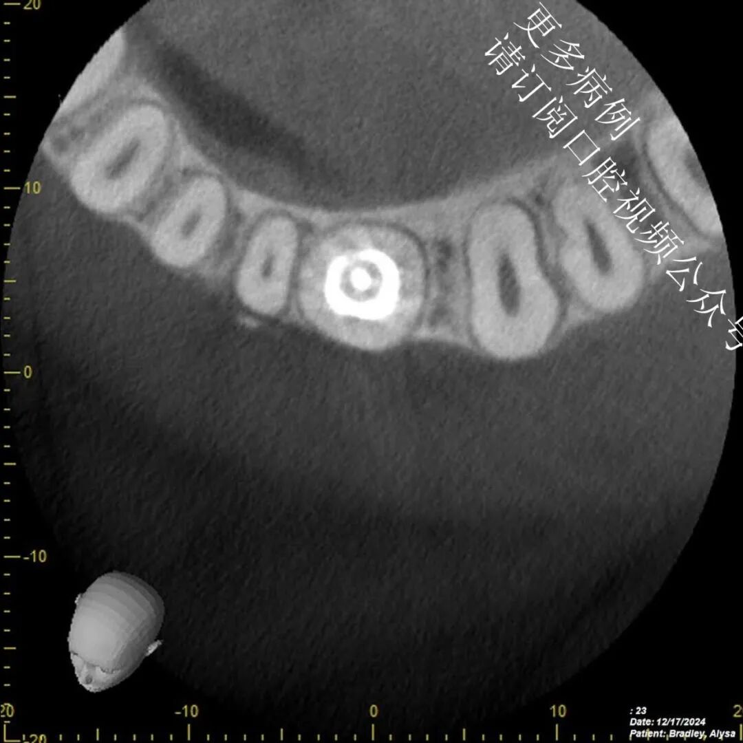 一个比较棘手的根管治疗案例