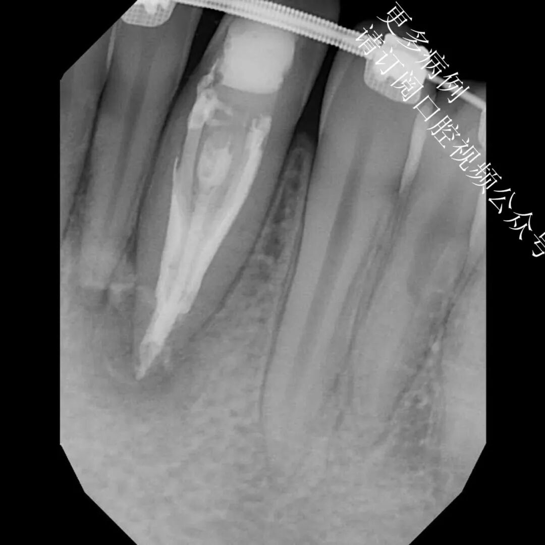 一个比较棘手的根管治疗案例