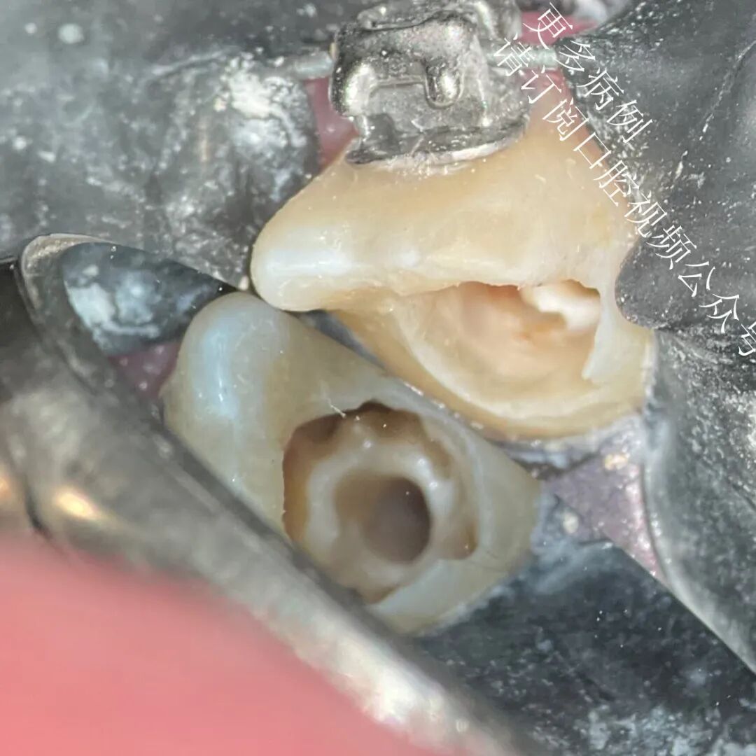 一个比较棘手的根管治疗案例