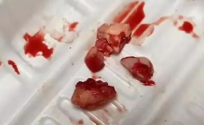 刮匙怎么使用牙龈分离器、刮匙简介_https://www.jmylbn.com_新闻资讯_第18张