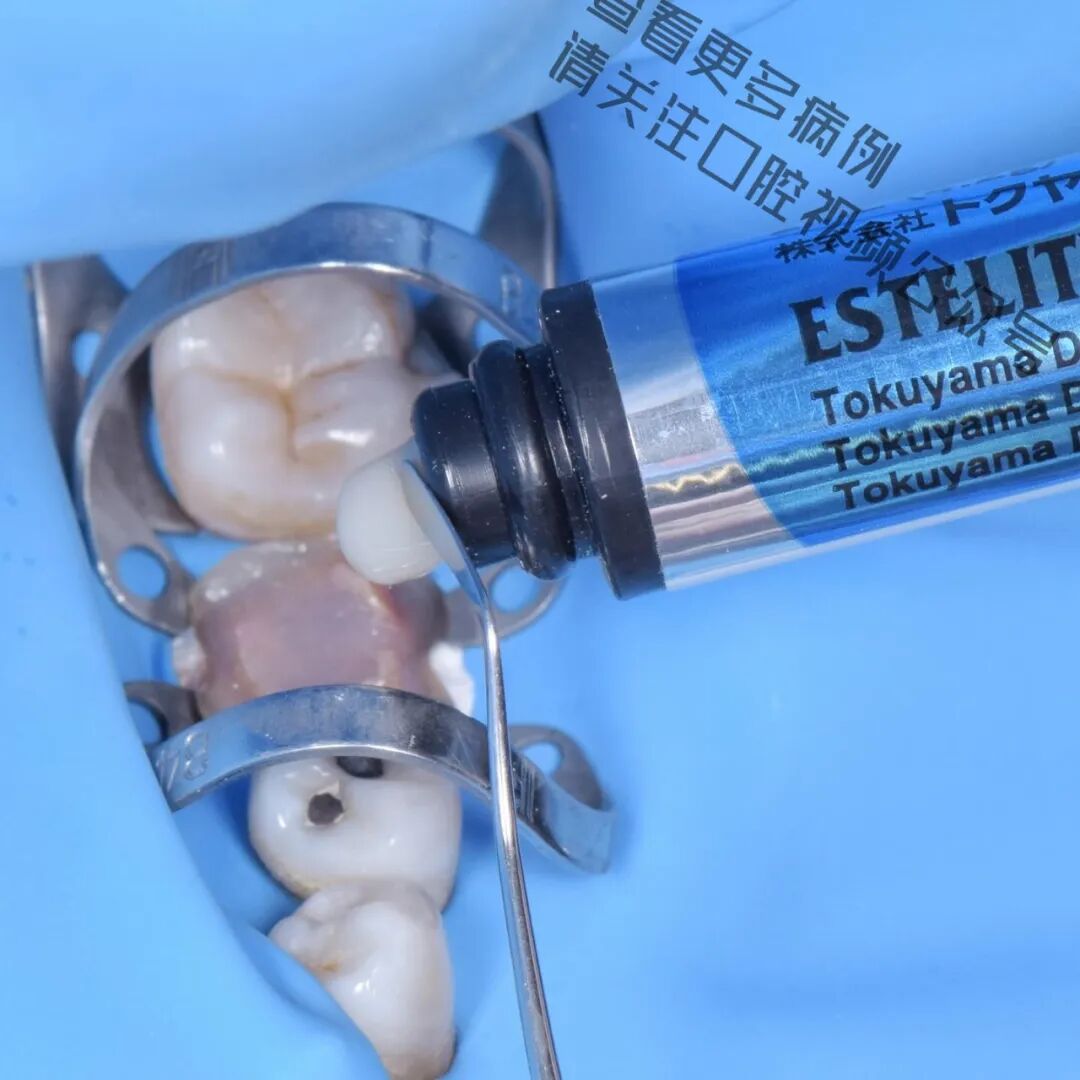 一颗濒临拔除的患牙，仿生学来修复它