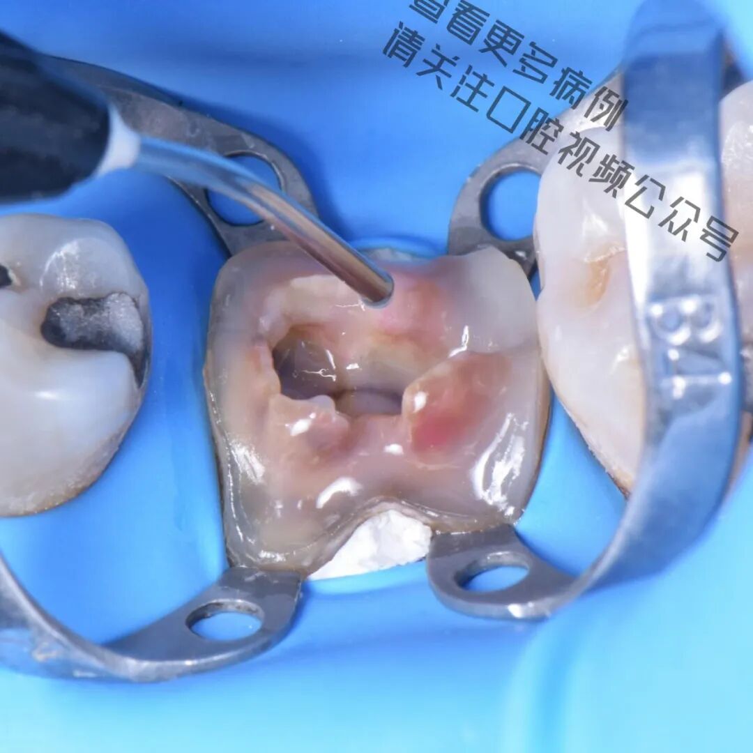 一颗濒临拔除的患牙，仿生学来修复它