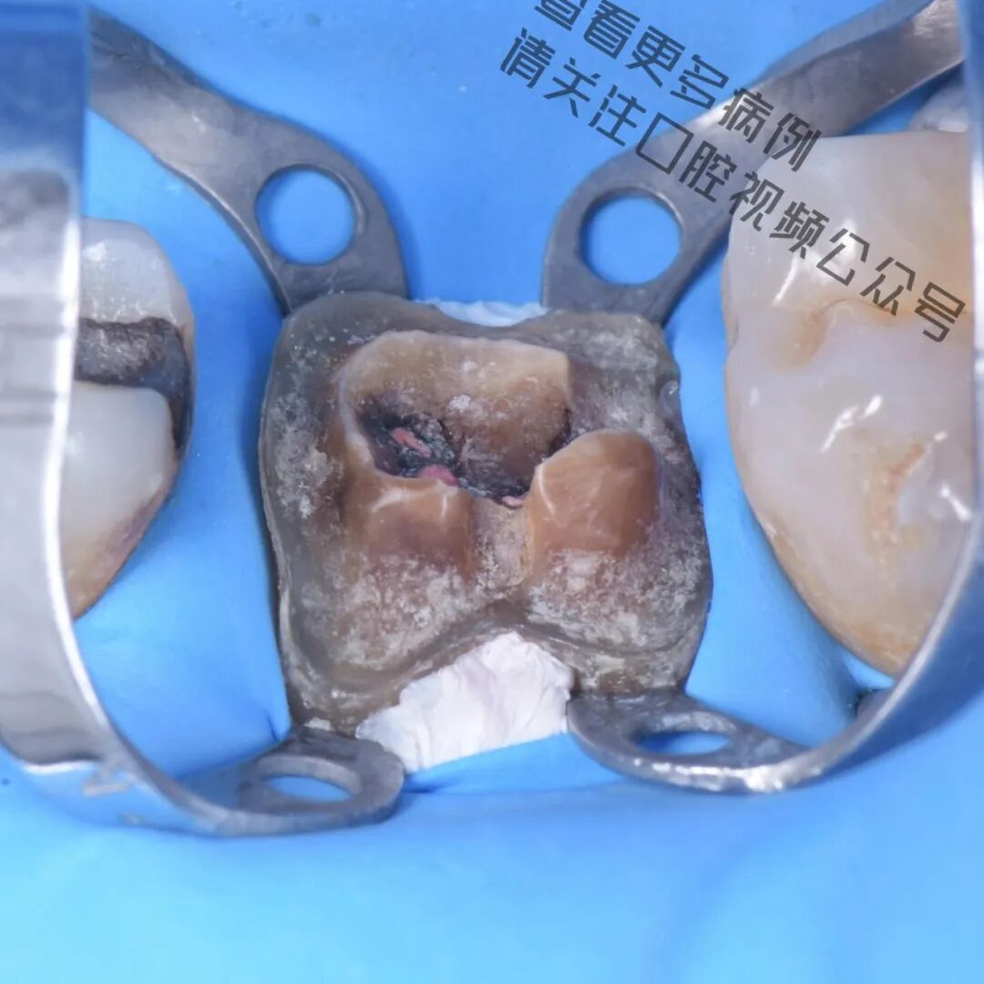 一颗濒临拔除的患牙，仿生学来修复它