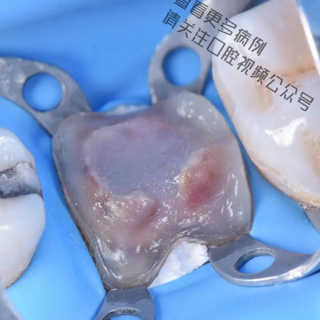 一颗濒临拔除的患牙，仿生学来修复它