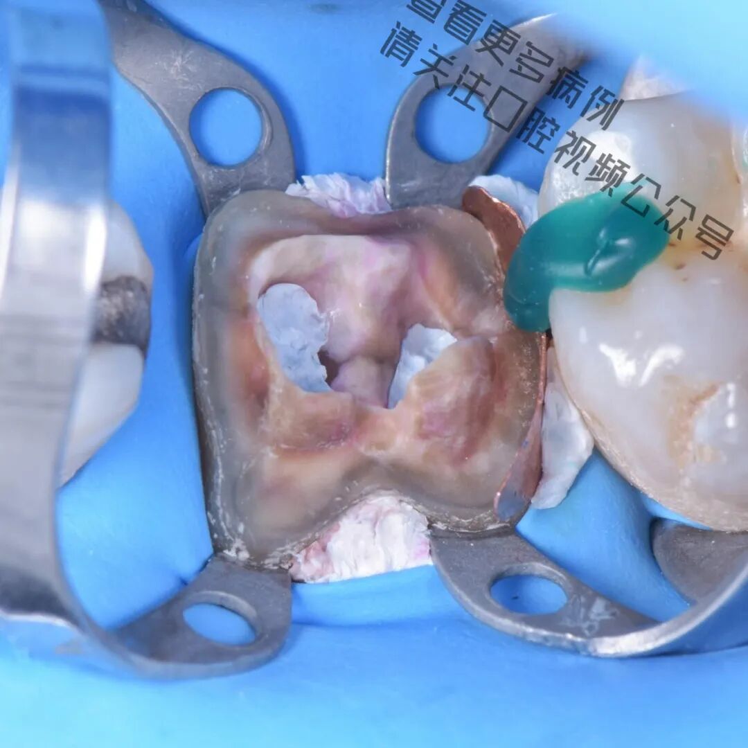 一颗濒临拔除的患牙，仿生学来修复它