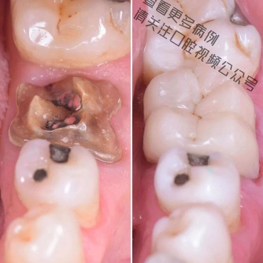 一颗濒临拔除的患牙，仿生学来修复它