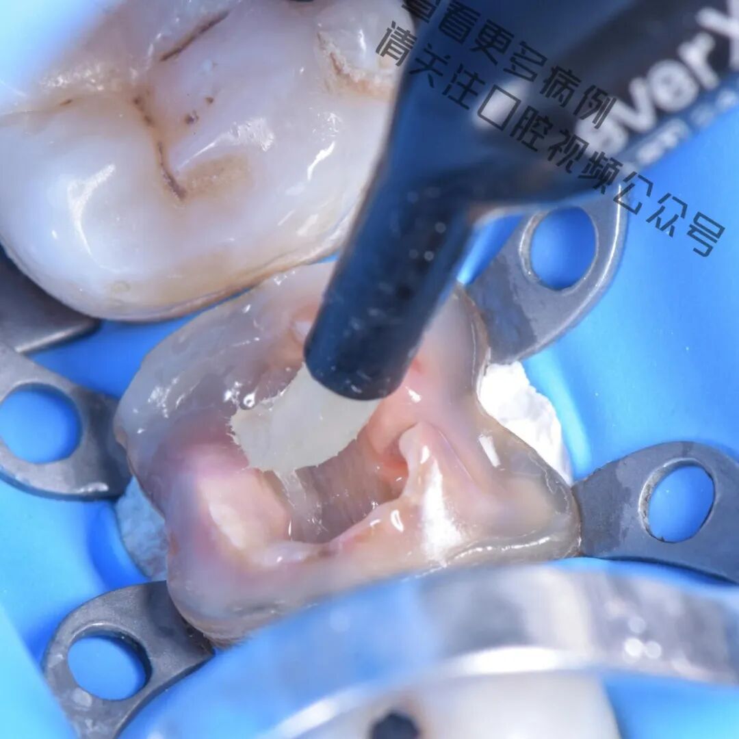 一颗濒临拔除的患牙，仿生学来修复它