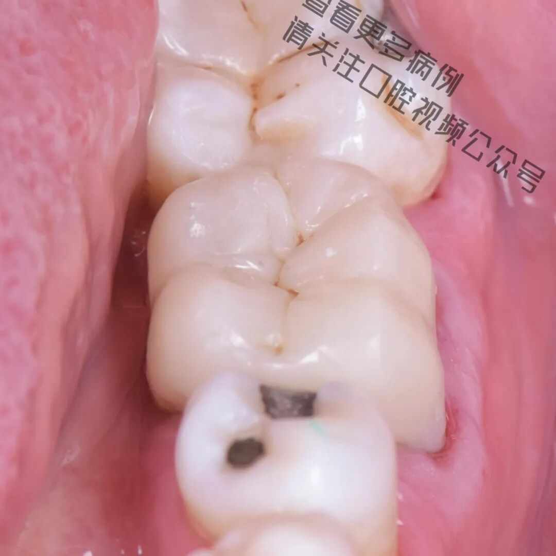 一颗濒临拔除的患牙，仿生学来修复它