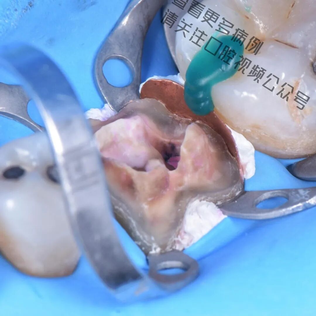 一颗濒临拔除的患牙，仿生学来修复它