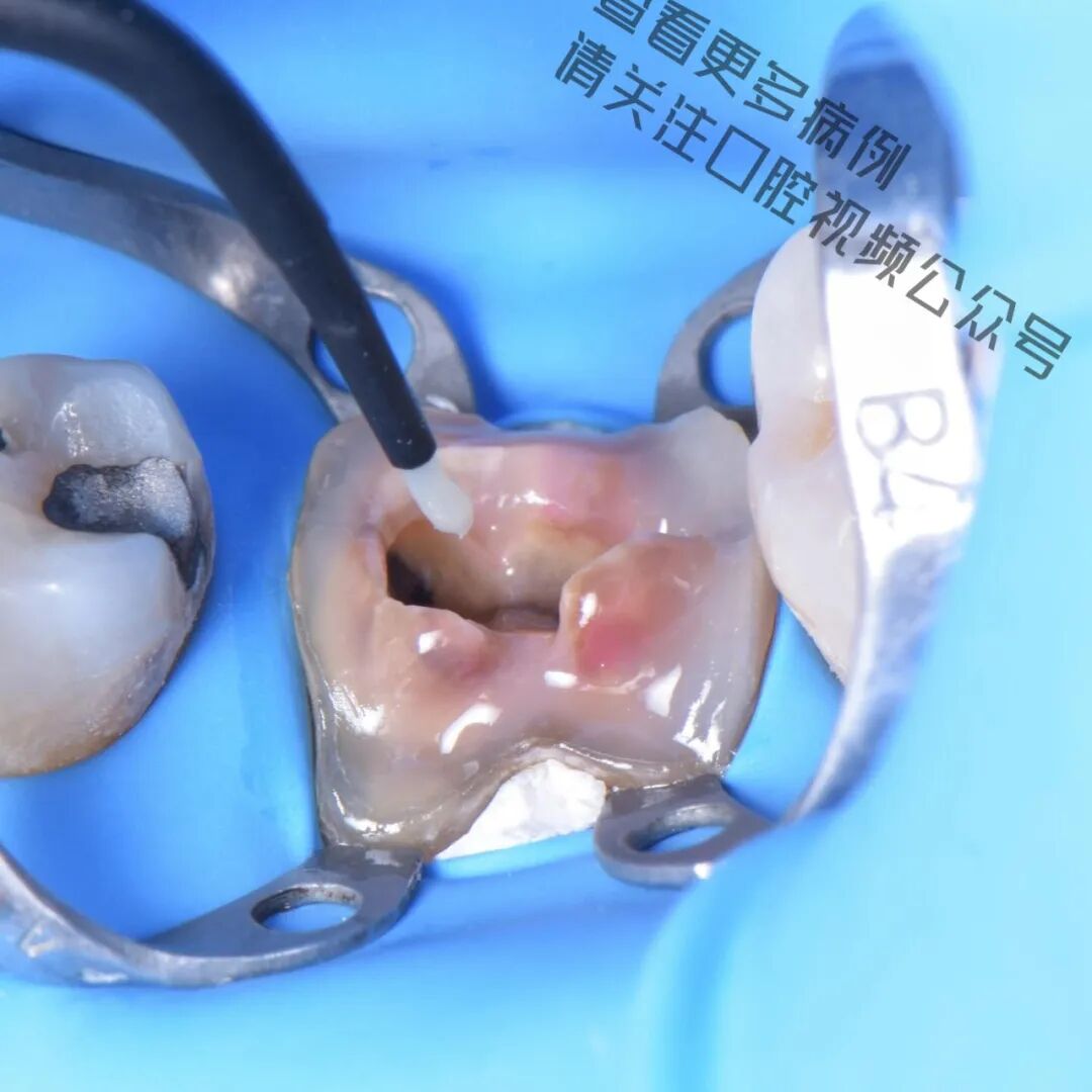 一颗濒临拔除的患牙，仿生学来修复它