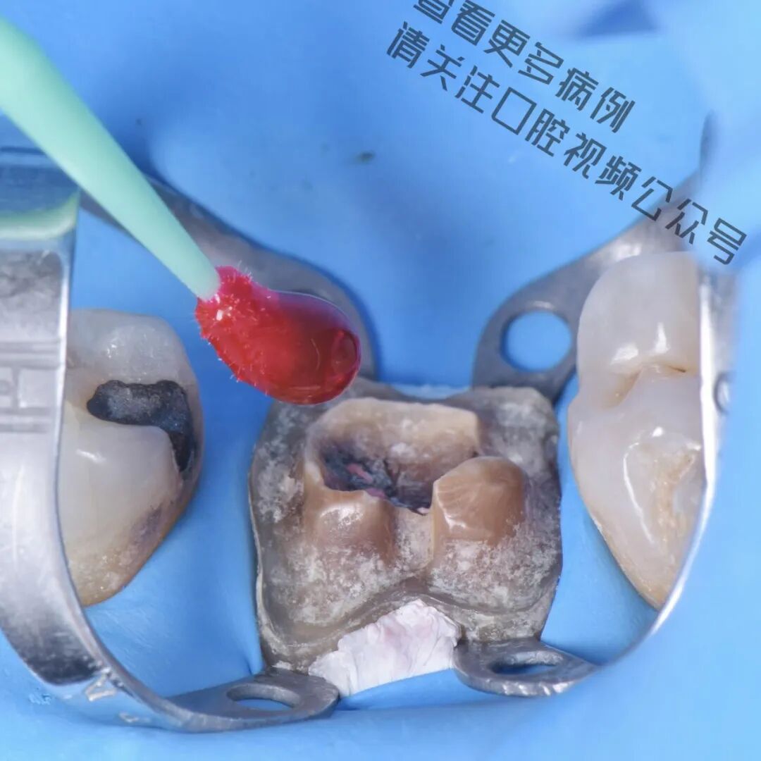 一颗濒临拔除的患牙，仿生学来修复它