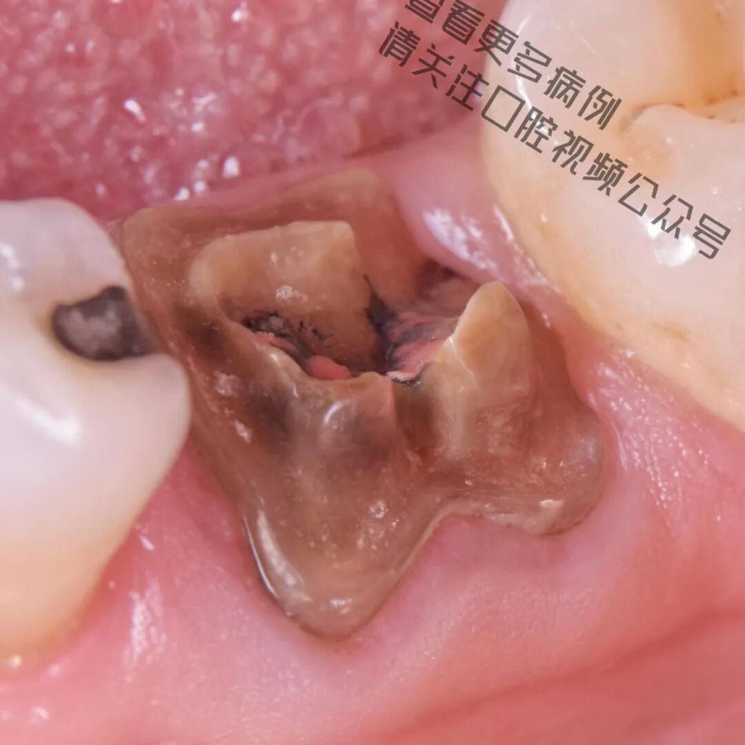 一颗濒临拔除的患牙，仿生学来修复它