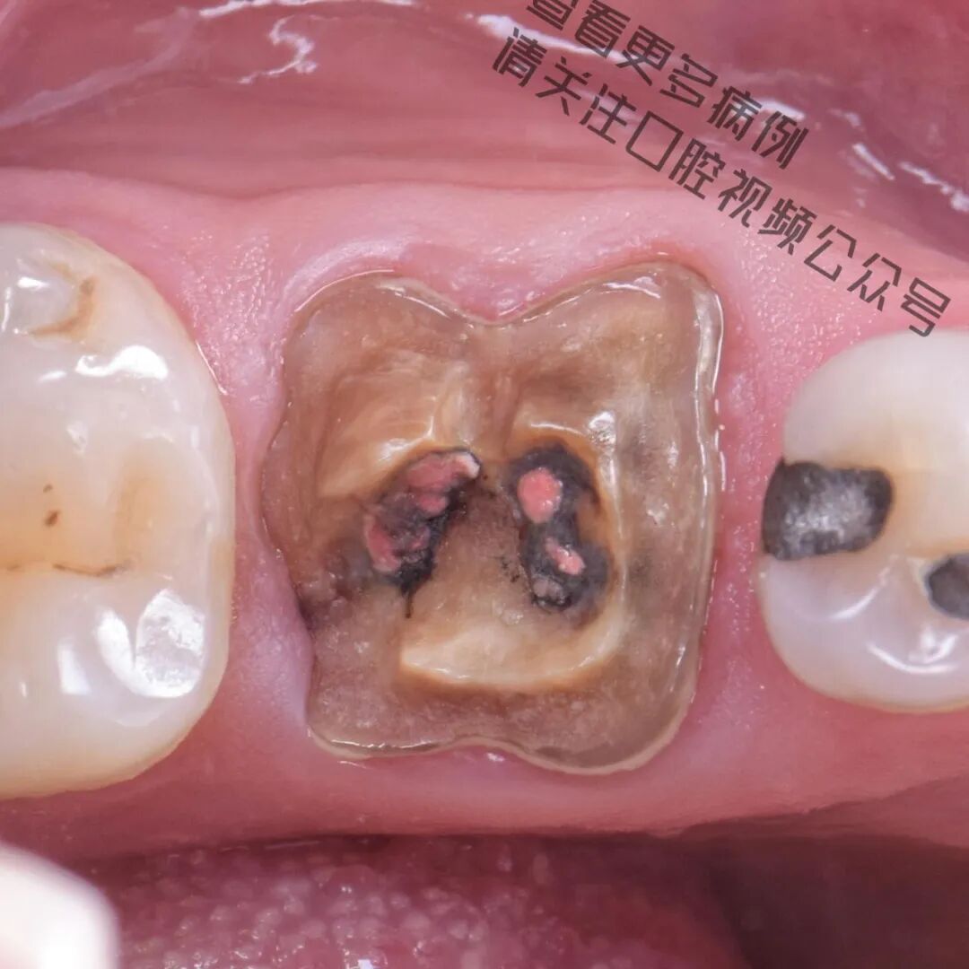 一颗濒临拔除的患牙，仿生学来修复它