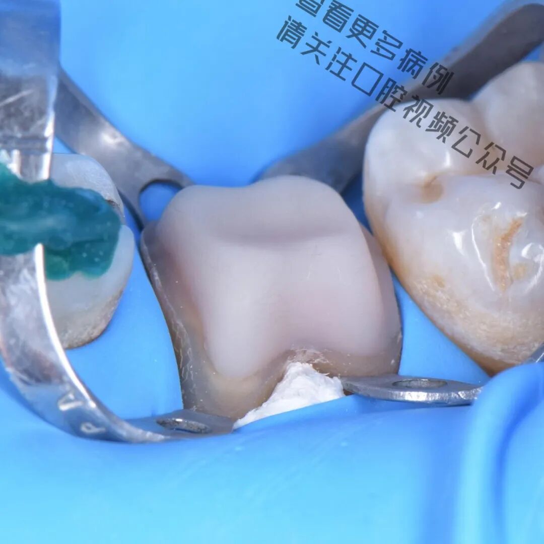 一颗濒临拔除的患牙，仿生学来修复它