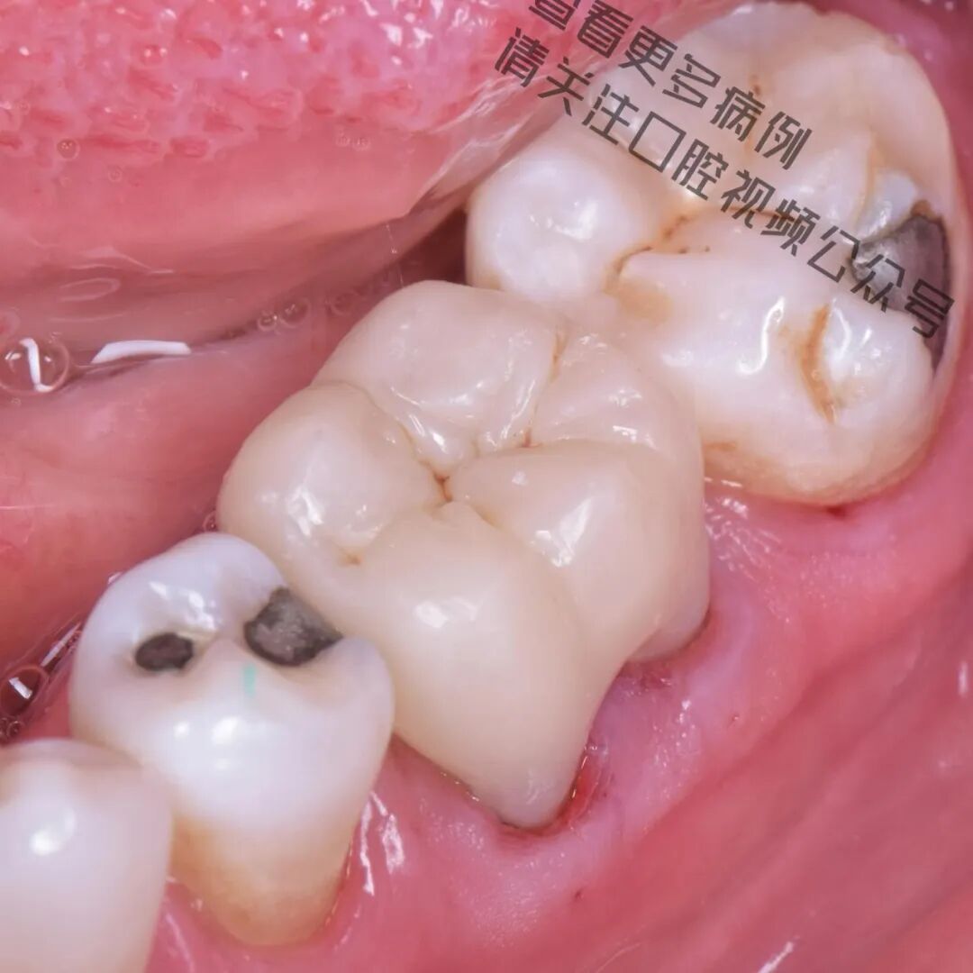 一颗濒临拔除的患牙，仿生学来修复它