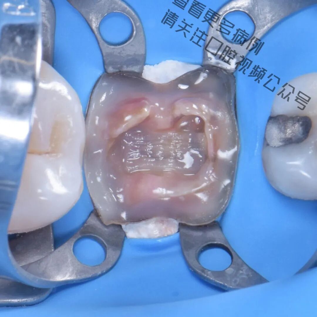 一颗濒临拔除的患牙，仿生学来修复它