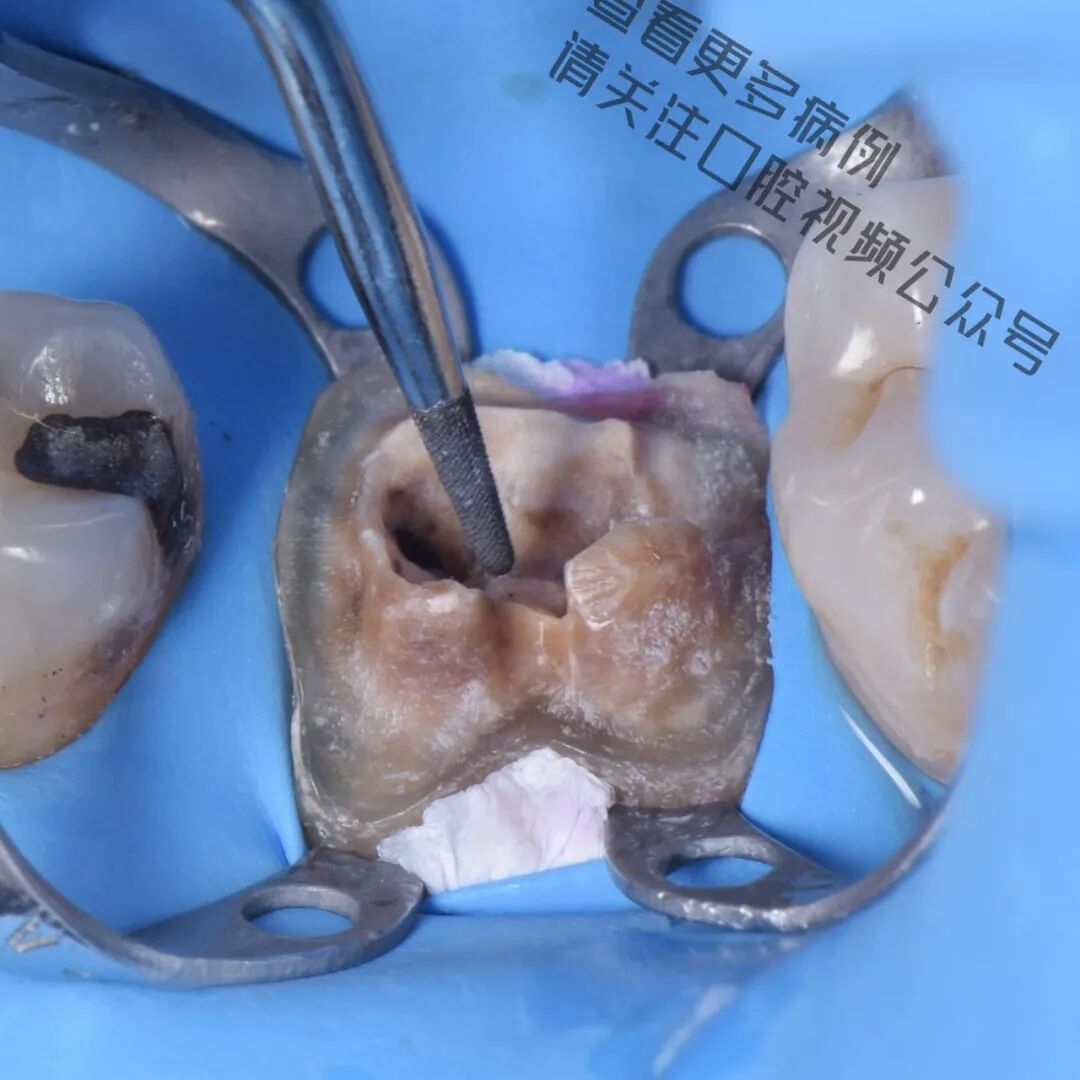 一颗濒临拔除的患牙，仿生学来修复它