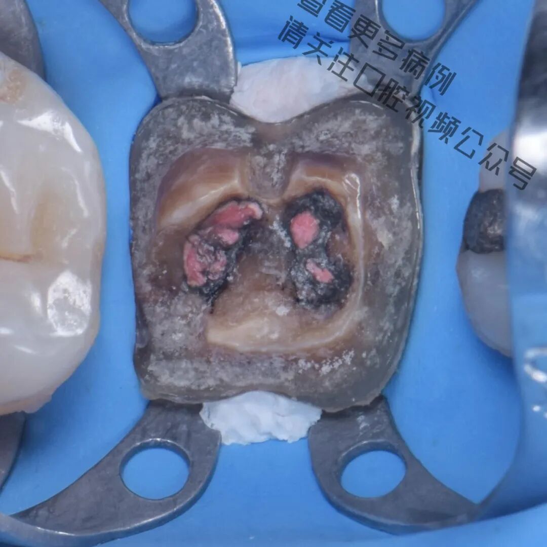 一颗濒临拔除的患牙，仿生学来修复它