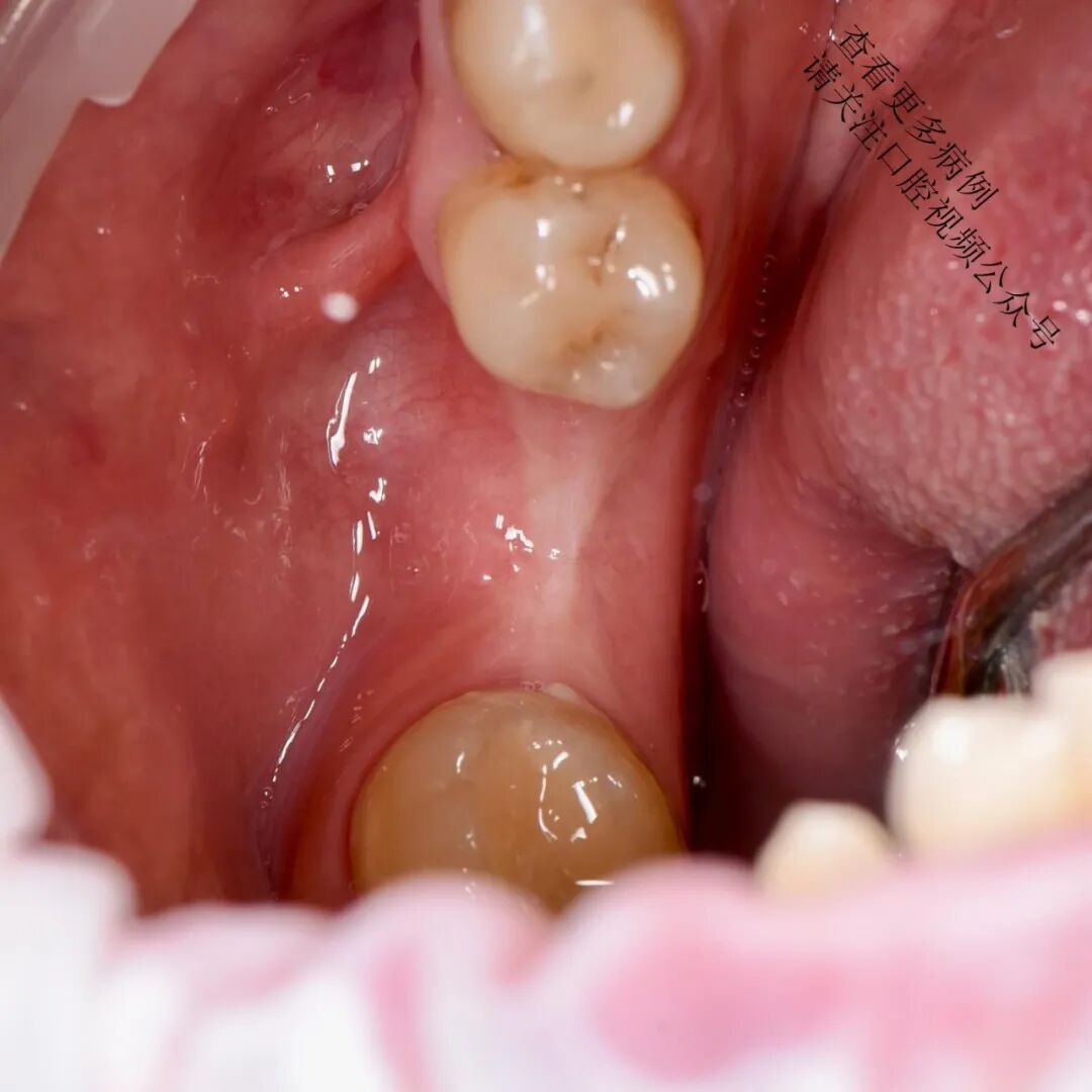 根向复位瓣术——增加种植体周围角化组织的体积