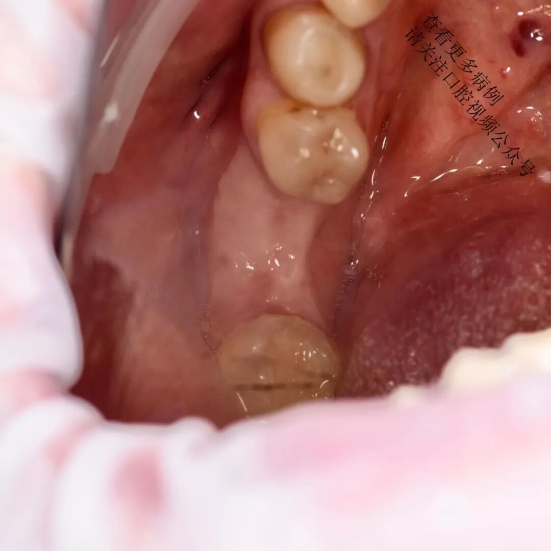根向复位瓣术——增加种植体周围角化组织的体积