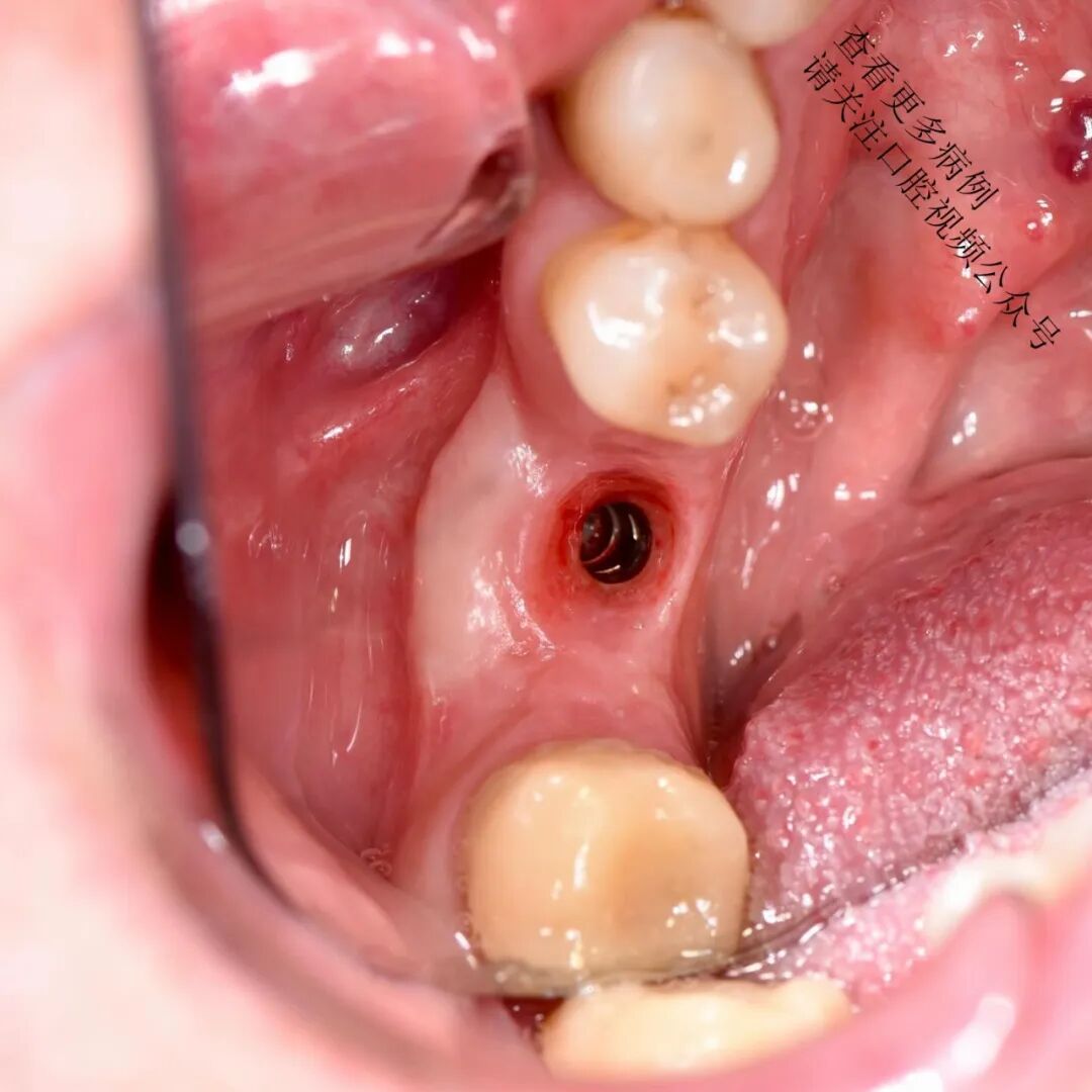 根向复位瓣术——增加种植体周围角化组织的体积