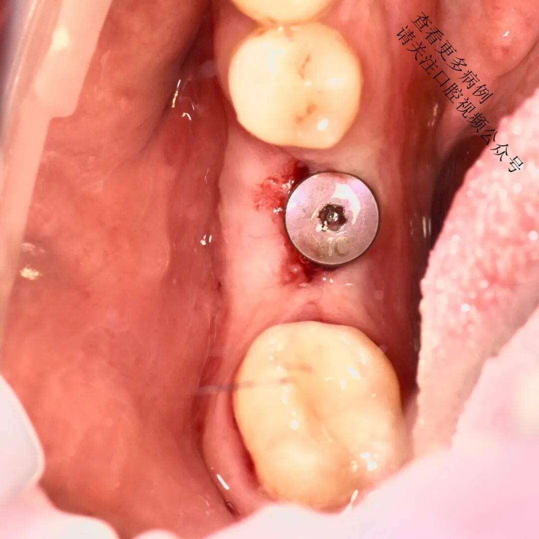 根向复位瓣术——增加种植体周围角化组织的体积