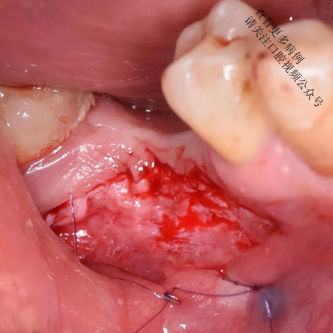 根向复位瓣术——增加种植体周围角化组织的体积