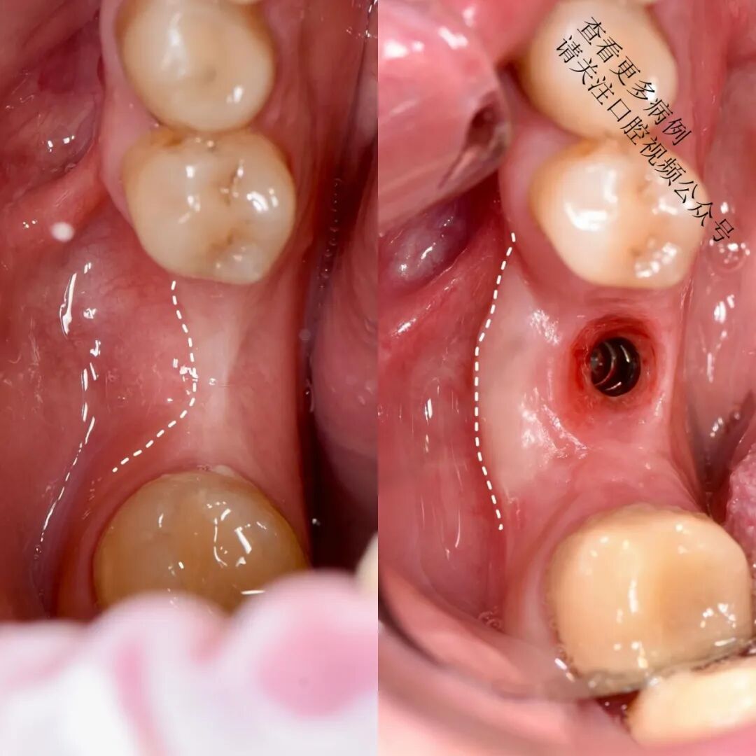 根向复位瓣术——增加种植体周围角化组织的体积