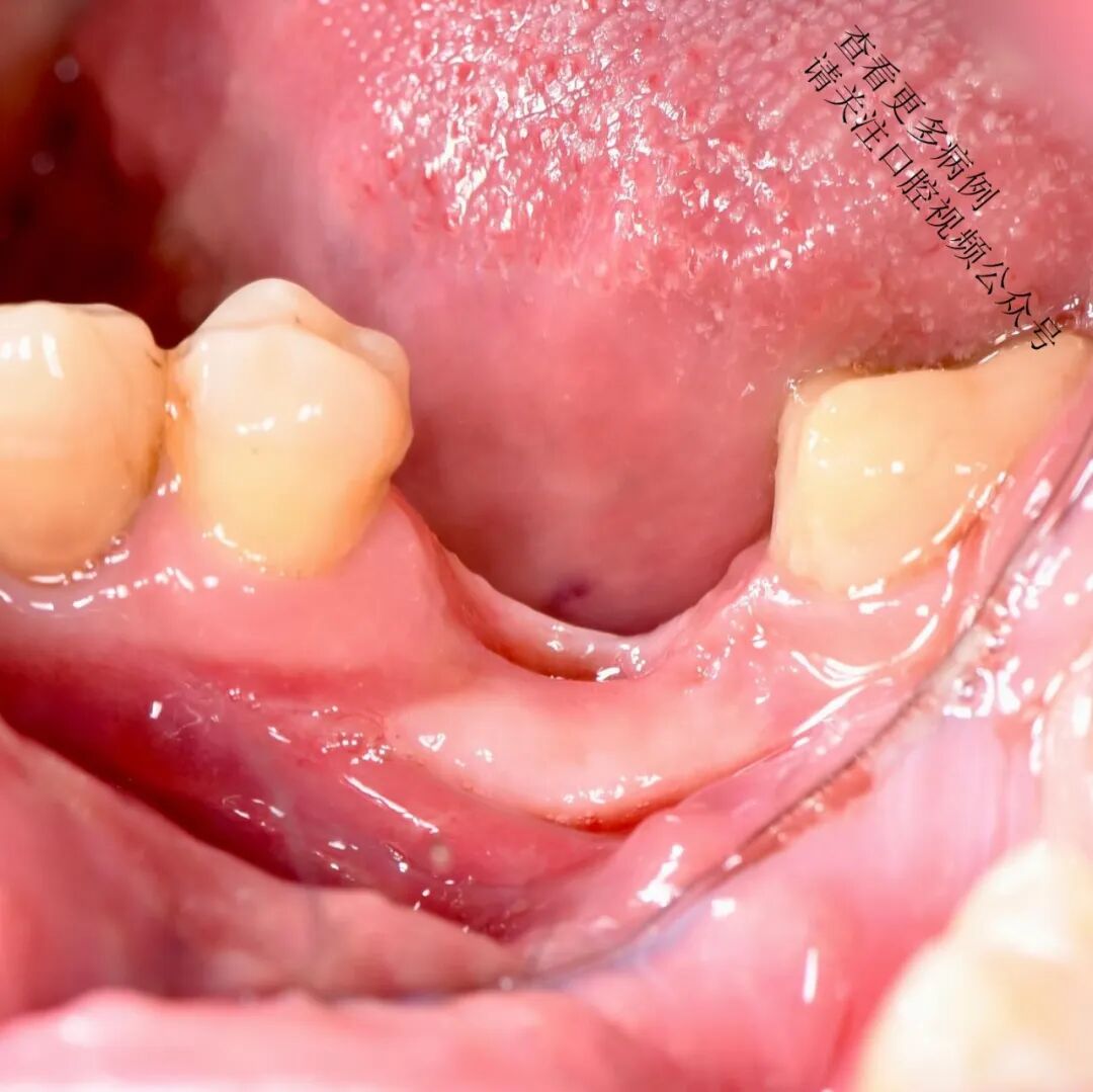 根向复位瓣术——增加种植体周围角化组织的体积
