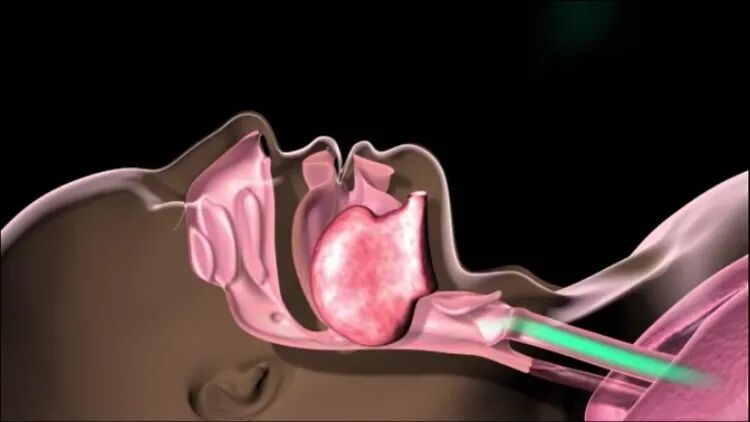 呼吸机怎么换氧气呼吸机里出来的是氧气吗？_https://www.jmylbn.com_新闻资讯_第4张
