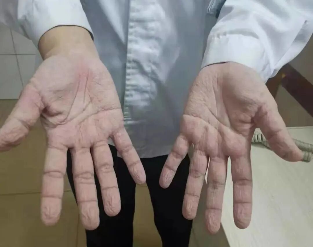 洗胃去什么科服药过量后喝下洗洁精水“洗胃”……广西脑科医院急诊科出手了！_https://www.jmylbn.com_新闻资讯_第8张