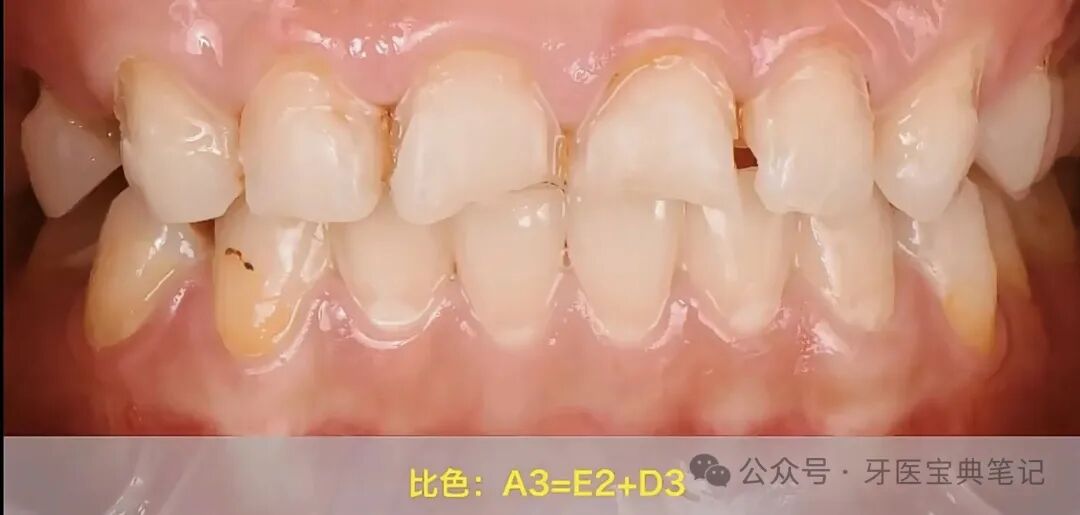 楔状缺损的补牙技巧！全是干货！