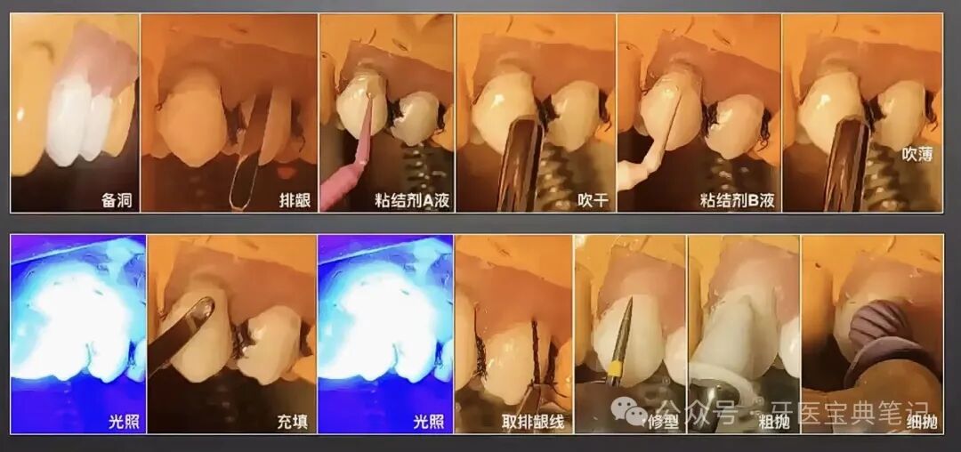 楔状缺损的补牙技巧！全是干货！