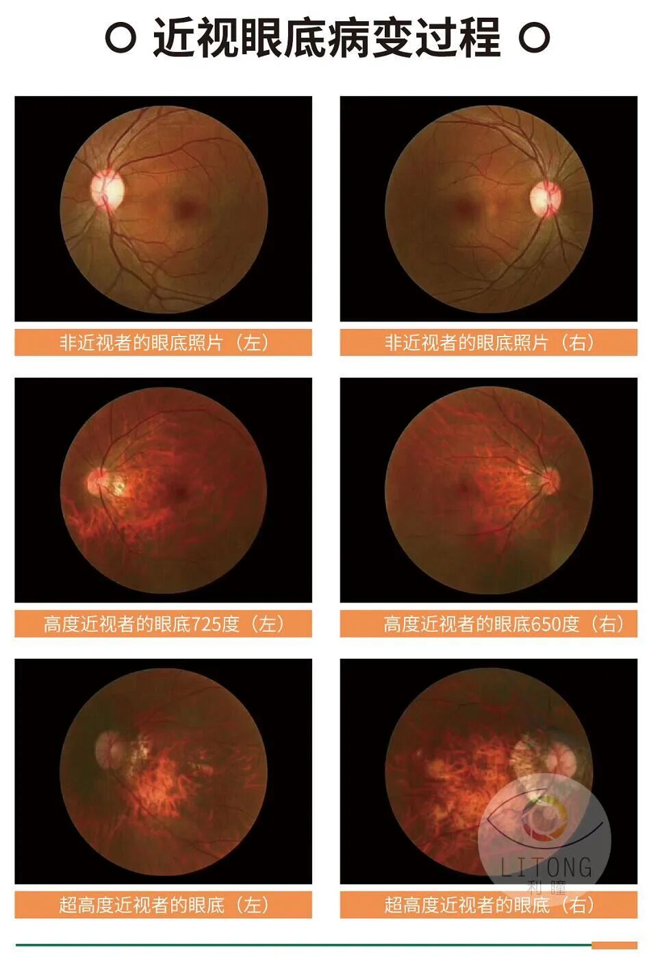 眼底照相有什么用眼底照相机的临床应用_https://www.jmylbn.com_新闻资讯_第2张
