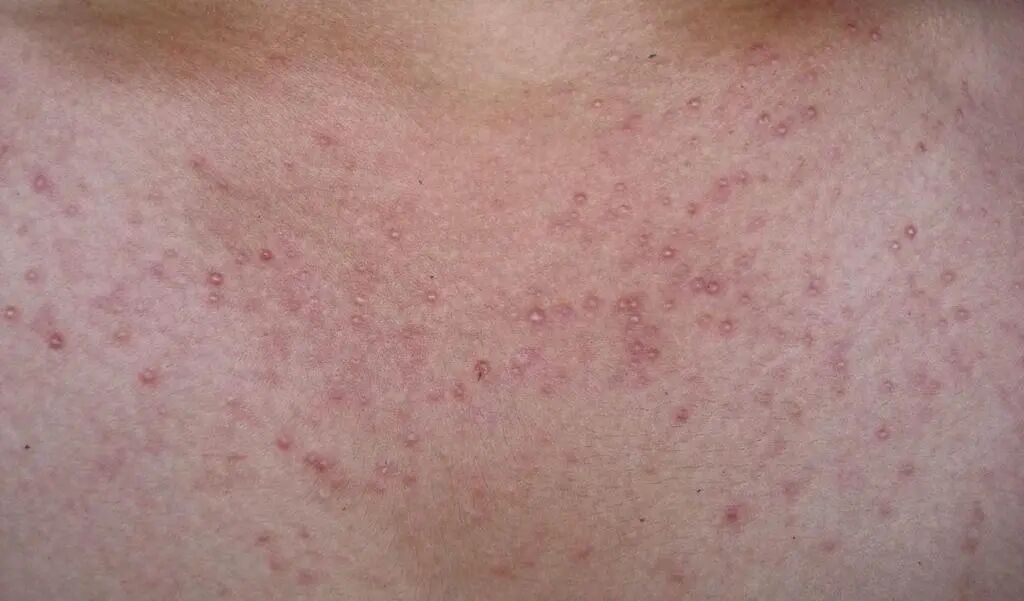 常见的毛囊炎治疗方法是什么？