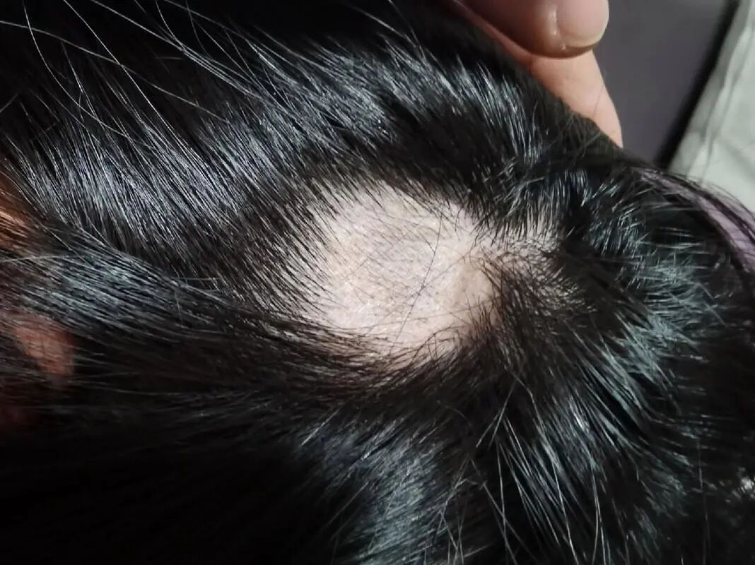 女生要如何进行斑秃的日常护理？