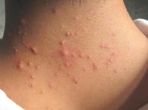 毛囊炎有哪些常见的治疗方法？