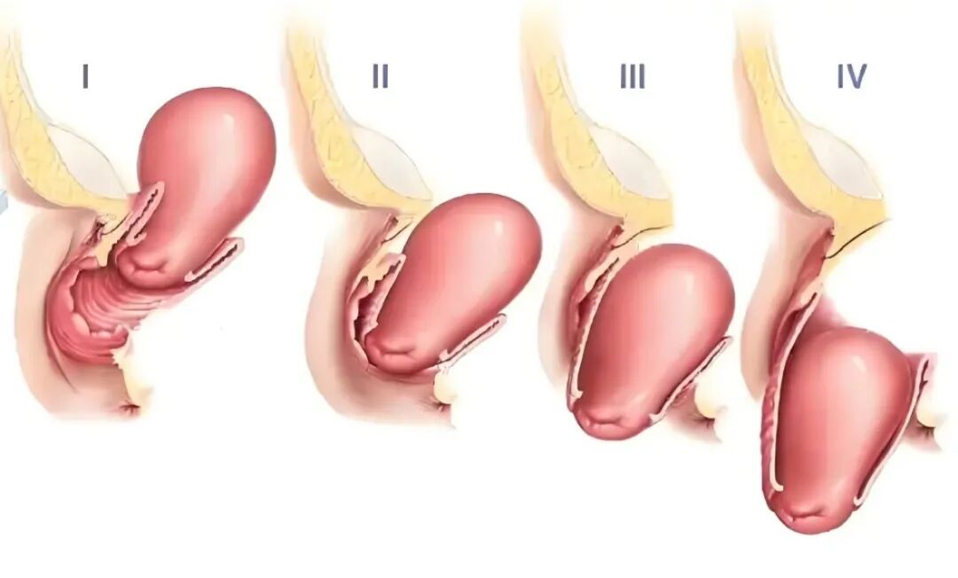 子宫支架怎么上告别“脱垂”与“漏尿”：阴道子宫托使用全指南_https://www.jmylbn.com_新闻资讯_第2张