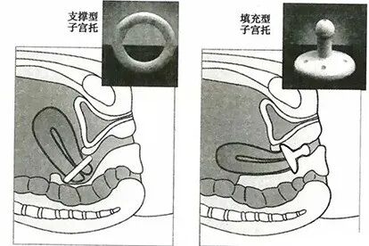 子宫支架怎么上告别“脱垂”与“漏尿”：阴道子宫托使用全指南_https://www.jmylbn.com_新闻资讯_第3张